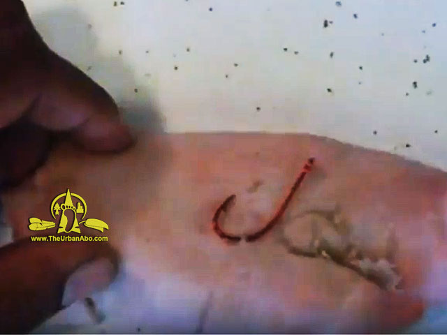  How to: Remove a Fishhook -  Technique 1: String Wrap & Pull 